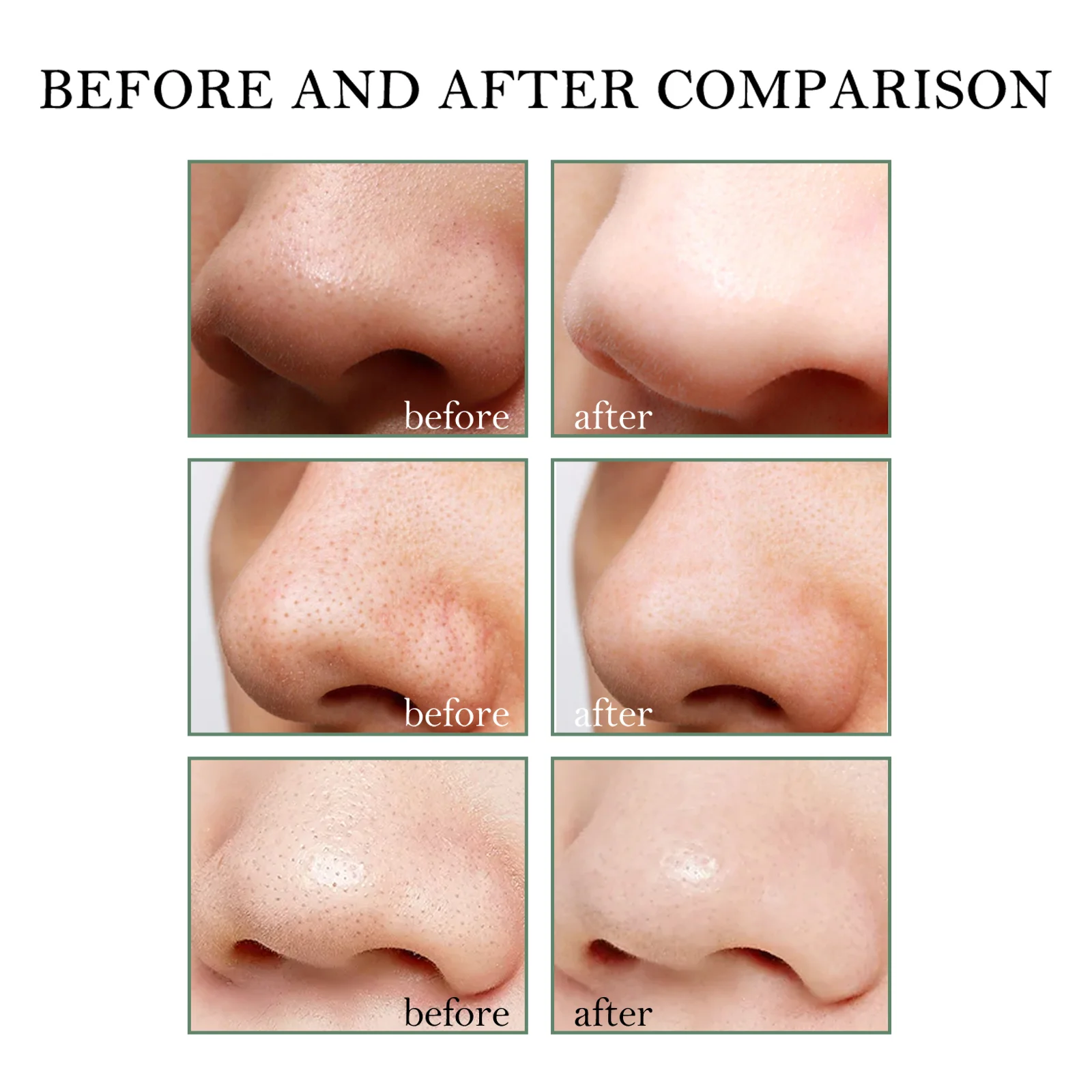 Blackhead Remover Cream & 40Pcs Pore Strips - Natural Skincare Set